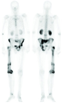 bone scan